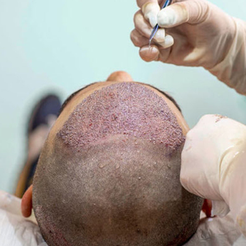 Bio-Enhanced-Hair-Transplant-Dubai
