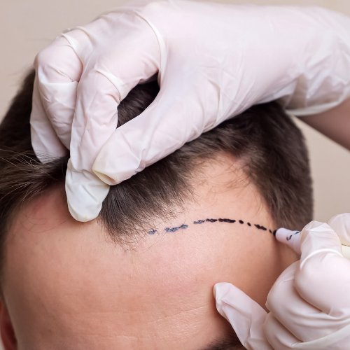 Hairline transplant