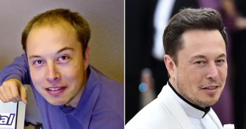 Elon Musk Hair Transplant