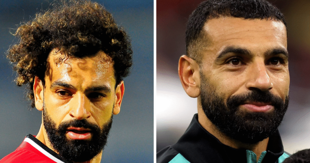 Mo Salah Hair Transplant