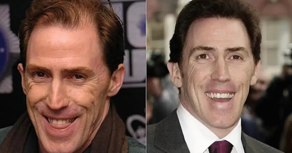 Rob Brydon Hair Transplant