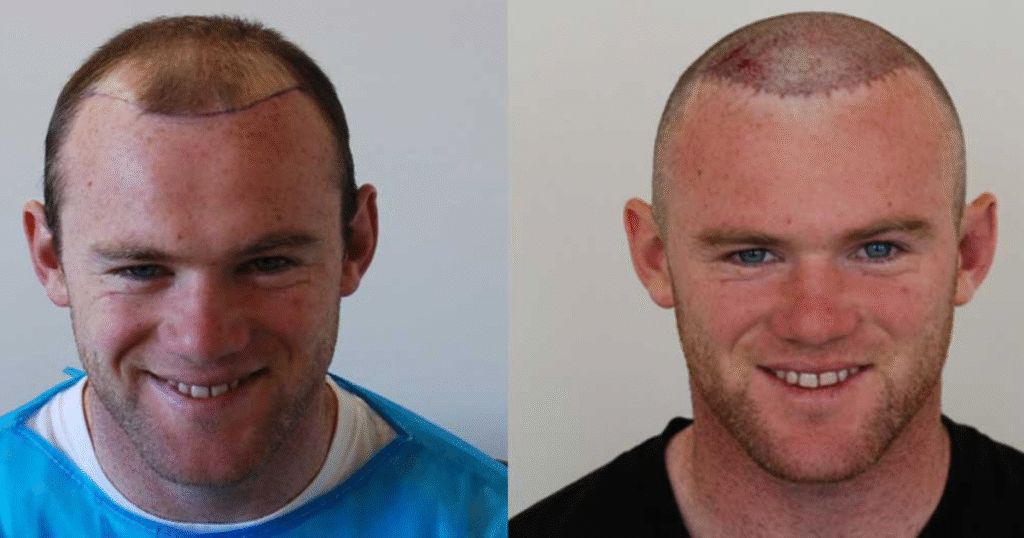 Wayne Rooney Hair Transplant