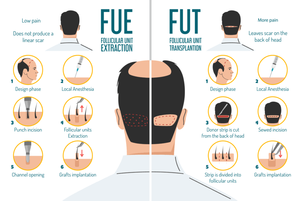 fue-vs-fut-hair-transplant-infographic
