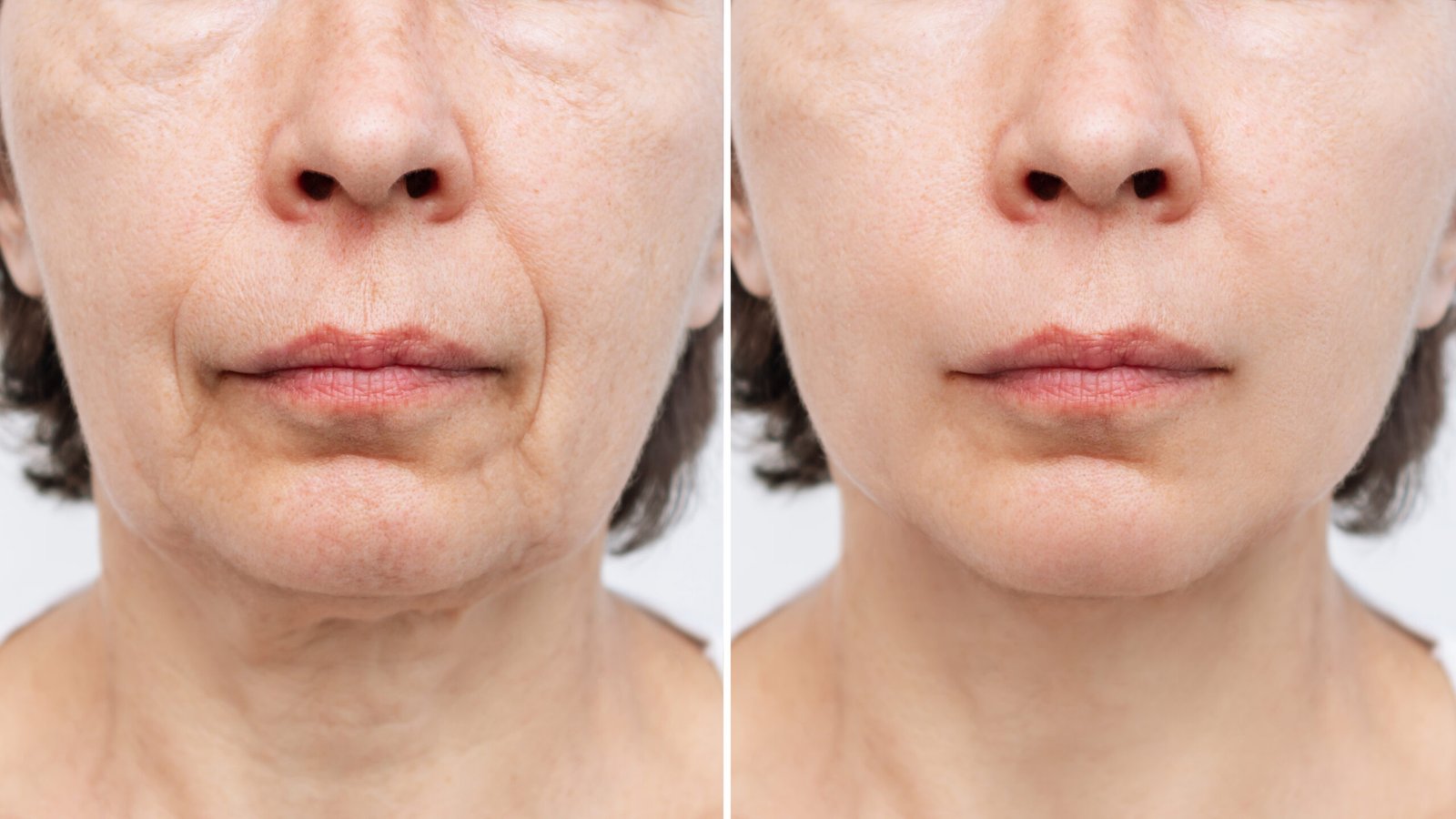 lower-part-face-neck-elderly-woman-with-signs-skin-aging-before-after-facelift