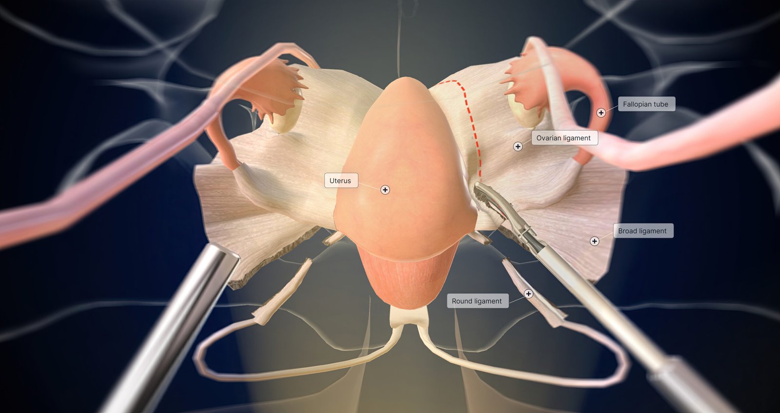 MTF Bottom Surgery: A Complete Guide for Trans Women 1 clipping ligating fallopian tubes ovarian ligaments scaled