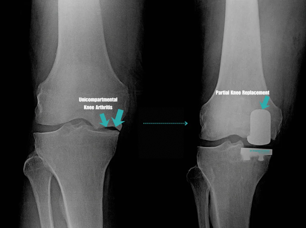 Total vs Partial Knee Replacement: Which Do You Need? 1 Partial Knee Replacement 1 1024x765 1