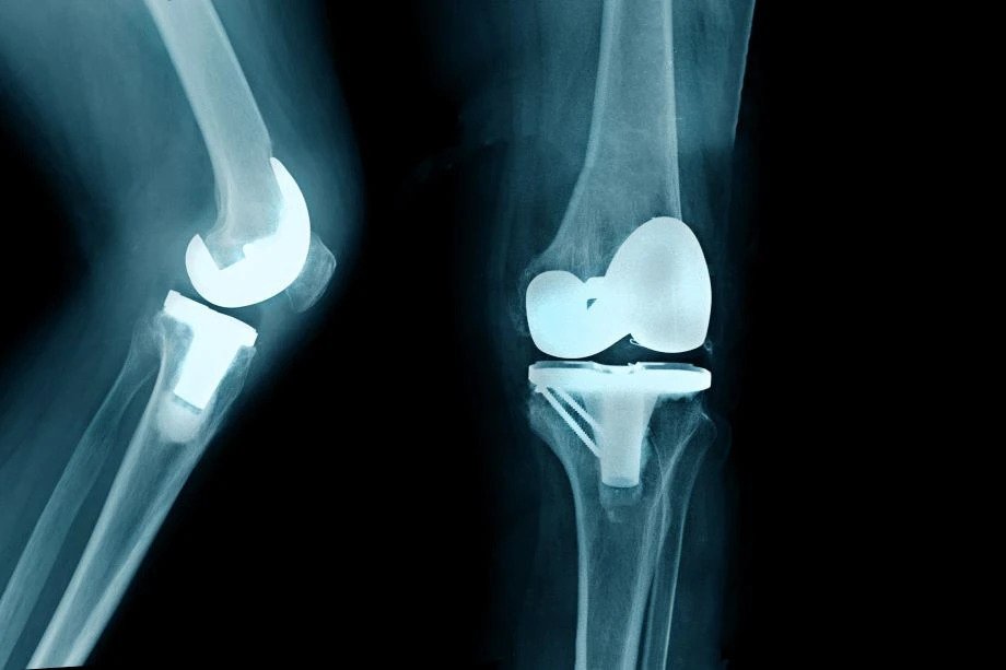 Can You Have Both Knees Replaced at Once? A Guide to Bilateral Knee Replacement 1 orthocarolina bilateralkneereplacement