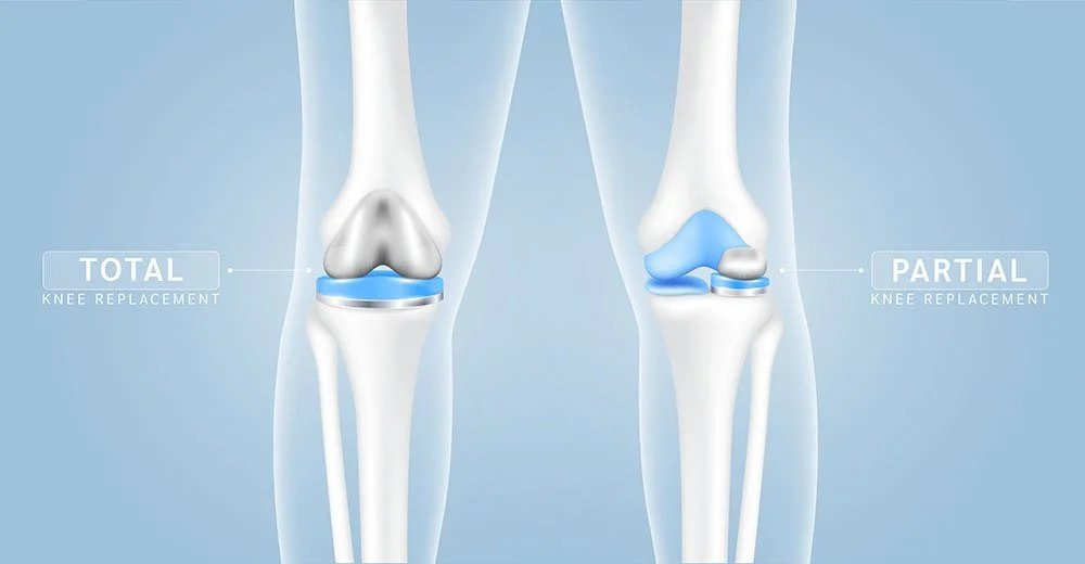 Total vs Partial Knee Replacement: Which Do You Need? 4 partial vs total knee replacement