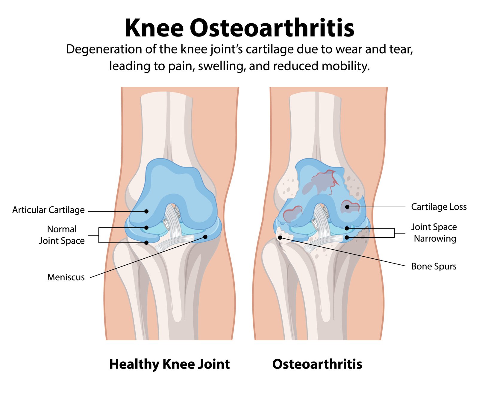How Do You Know If You Need a Knee Replacement? 1 222491656 be92ffa5 f645 49ec b9a6 2fea6c907cb8 scaled