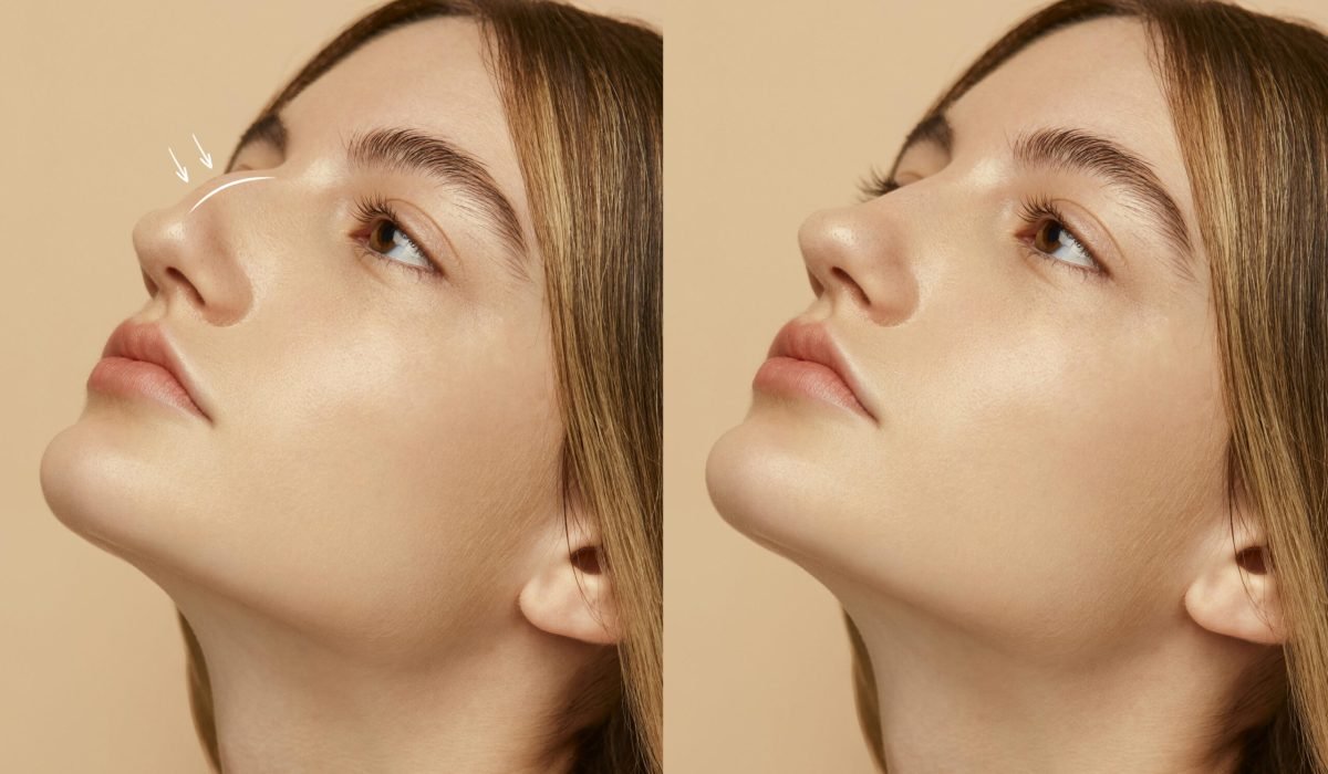 nose-job-surgery